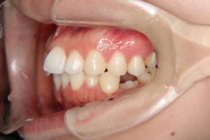 左下第二小臼歯は先天性欠如して乳歯が残っています